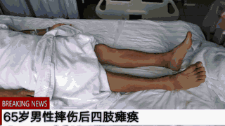 摔伤后颈髓损伤 四肢瘫痪,治疗20天后能下地活动了