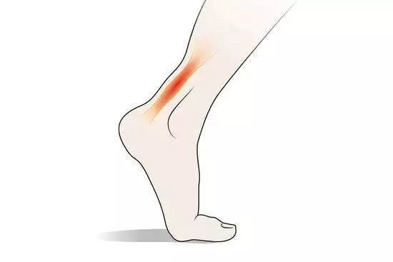 什么是跟腱炎,得了跟腱炎怎么办?黑金