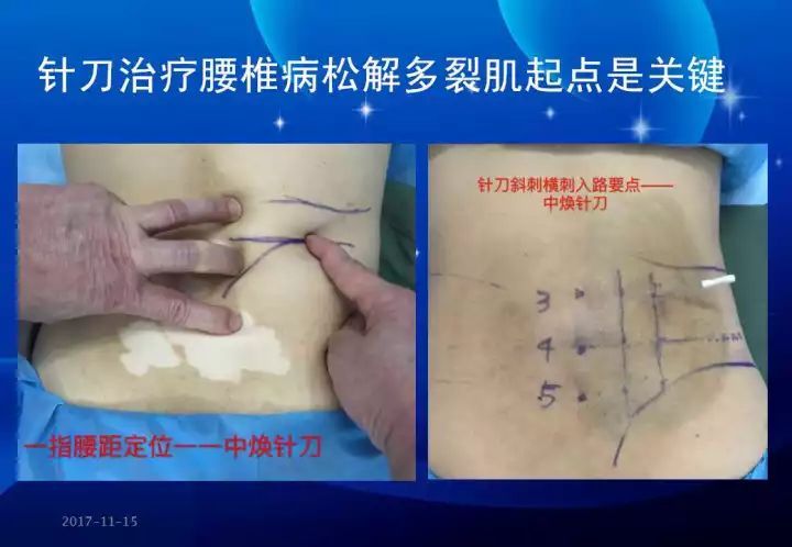 针刀微创如何精准诊疗颈腰椎病