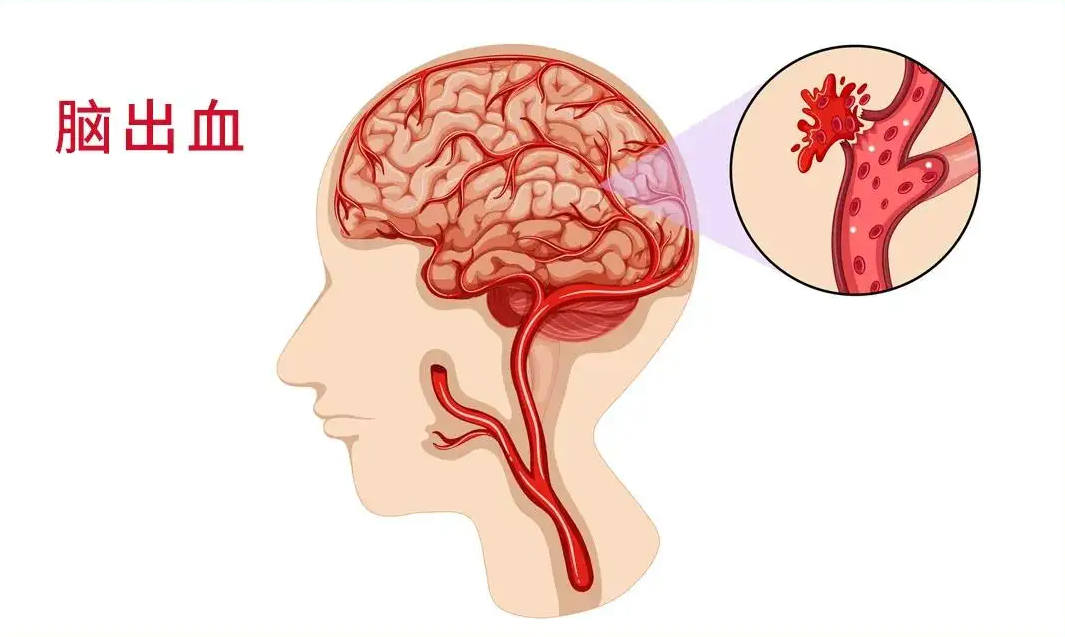 成人康复医院|脑出血患者如何进行康复训练？