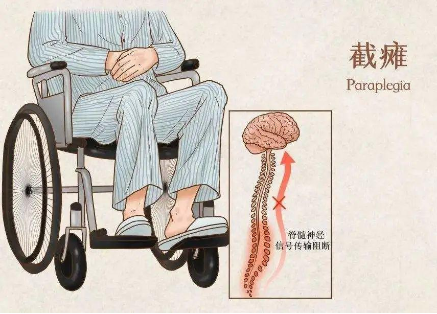 合肥康华康复医院|一图读懂脊髓损伤（截瘫）相关知识及康复方法
