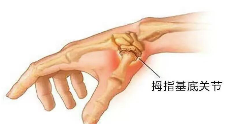 合肥康华康复医院 | 双侧腕关节骨性关节病：精准防治，守护腕部健康