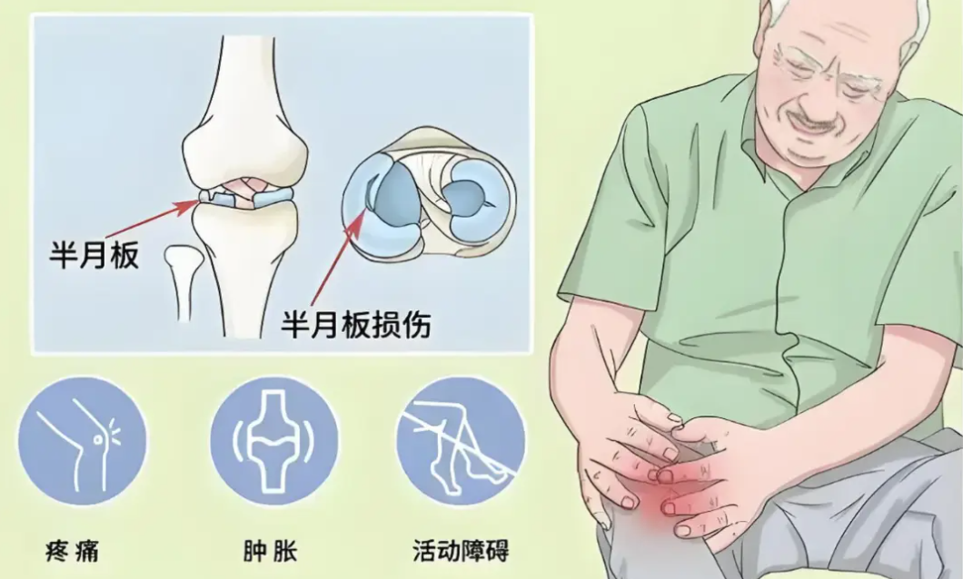 合肥康华康复医院 | 半月板损伤：膝关节的 “隐形伤痛” 与修复之道