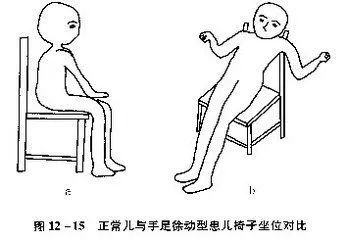 小儿脑瘫具体症状类型与康复训练患儿