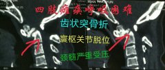 摔伤后四肢瘫痪，治疗一月后四肢活动自如脊髓