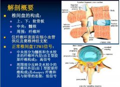 腰椎间盘突出症的影像学诊断和治疗