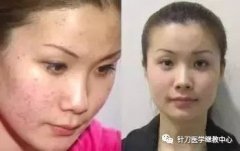脸上痤疮总不好，针刀治疗有诀窍！
