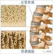 骨密度指标对照表，人手一份治疗