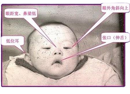 什么原因导致夫妻生＂唐氏综合征＂缺陷婴儿