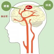 脑梗塞康复期如何做好康复训练