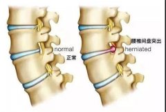 腰椎间盘突出不用慌，只要做到这一点，突出了也不腰疼！