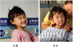 脑瘫+面部表情失控，女孩5年终于找回笑脸