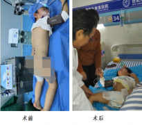 合肥康华医院帮助痉挛型脑瘫患儿站立