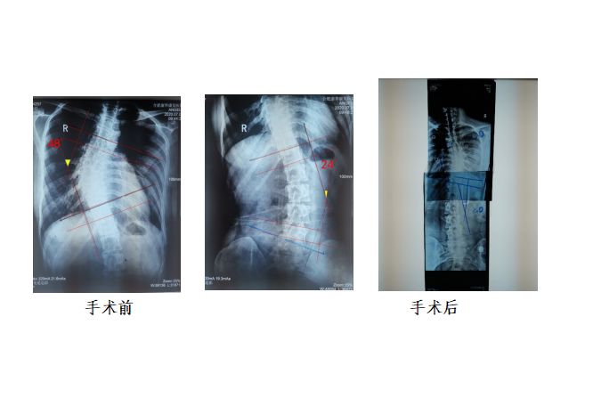 康复训练前后脊柱对比图