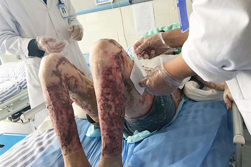 全身80烧伤卧床8月有余今下床行走