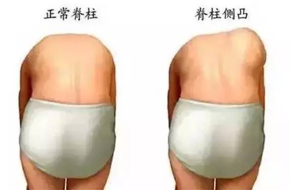 所罗门之匙-青少年特发性脊柱侧弯（二）