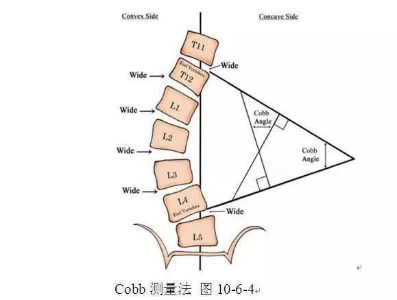 所罗门之匙-青少年特发性脊柱侧弯（二）