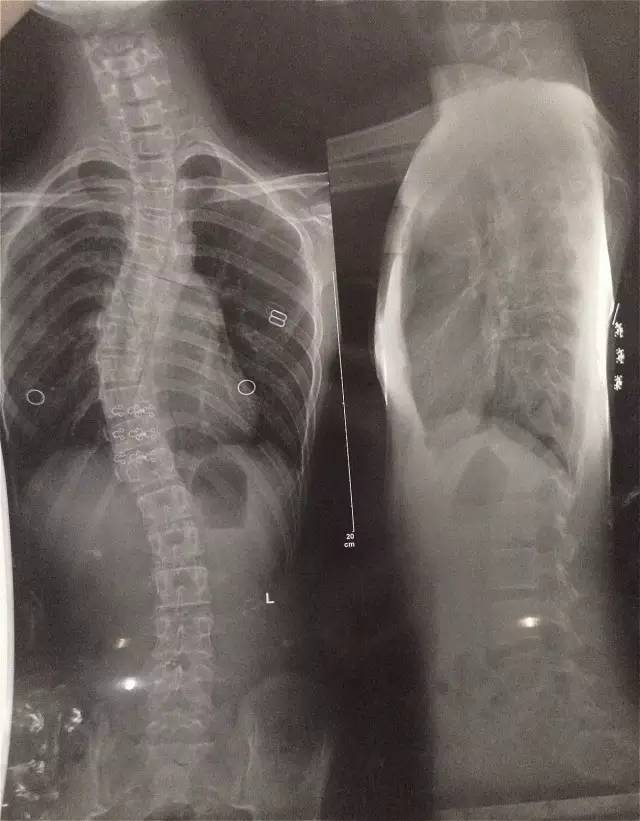 所罗门之匙-青少年特发性脊柱侧弯（二）