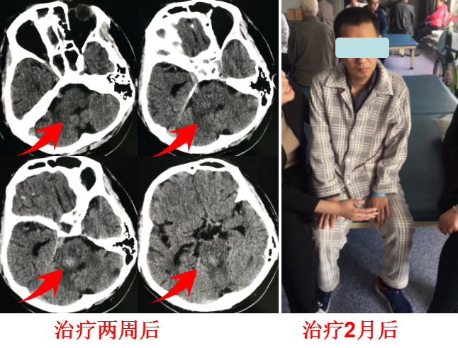 脑干出血还有救吗？其实很多还是有救的治疗