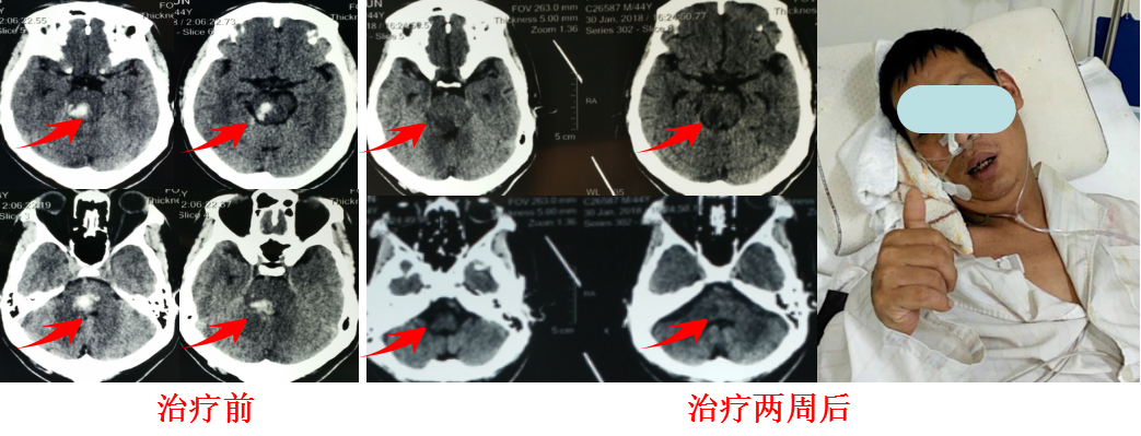 脑干出血还有救吗？其实很多还是有救的治疗