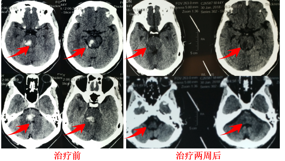 脑干出血还有救吗？其实很多还是有救的治疗