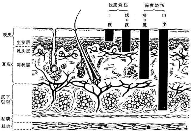 走进烧伤之-烧伤康复那些事儿！