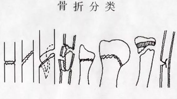 骨折后，伤口一直不愈合怎么办？进行