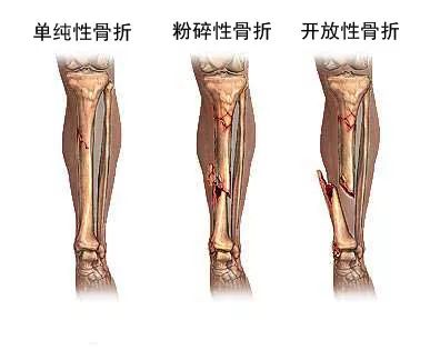 骨折后，伤口一直不愈合怎么办？进行