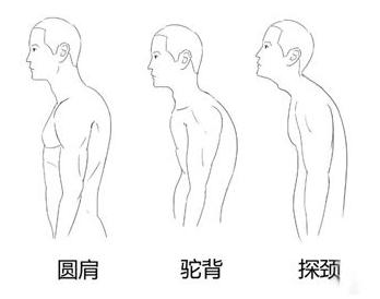 上交叉综合症的康复治疗策略肩胛