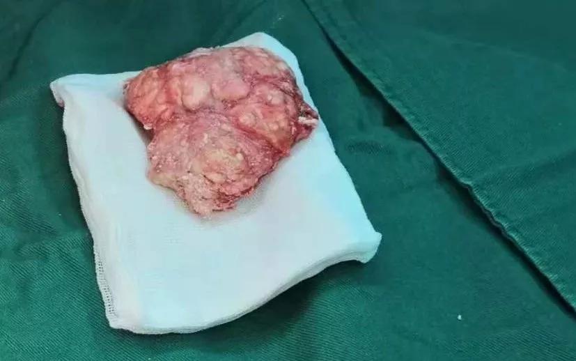触目惊心!男子脚趾关节取出＂鹅蛋大＂的痛风石!