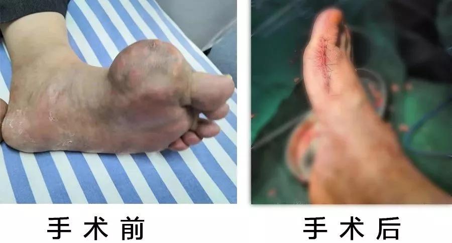 触目惊心!男子脚趾关节取出＂鹅蛋大＂的痛风石!