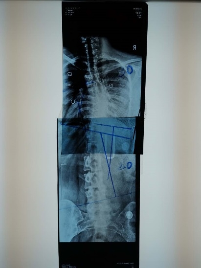 17岁少女的脊柱矫形变形记