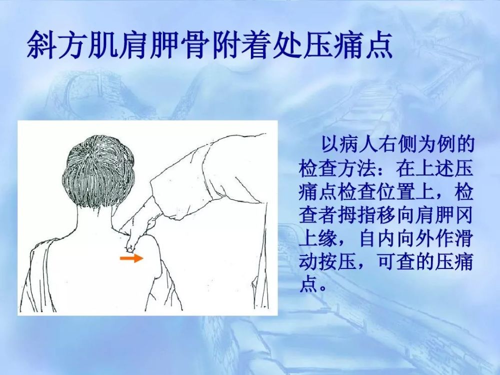 劳损性肌肉压痛点诊断检查法