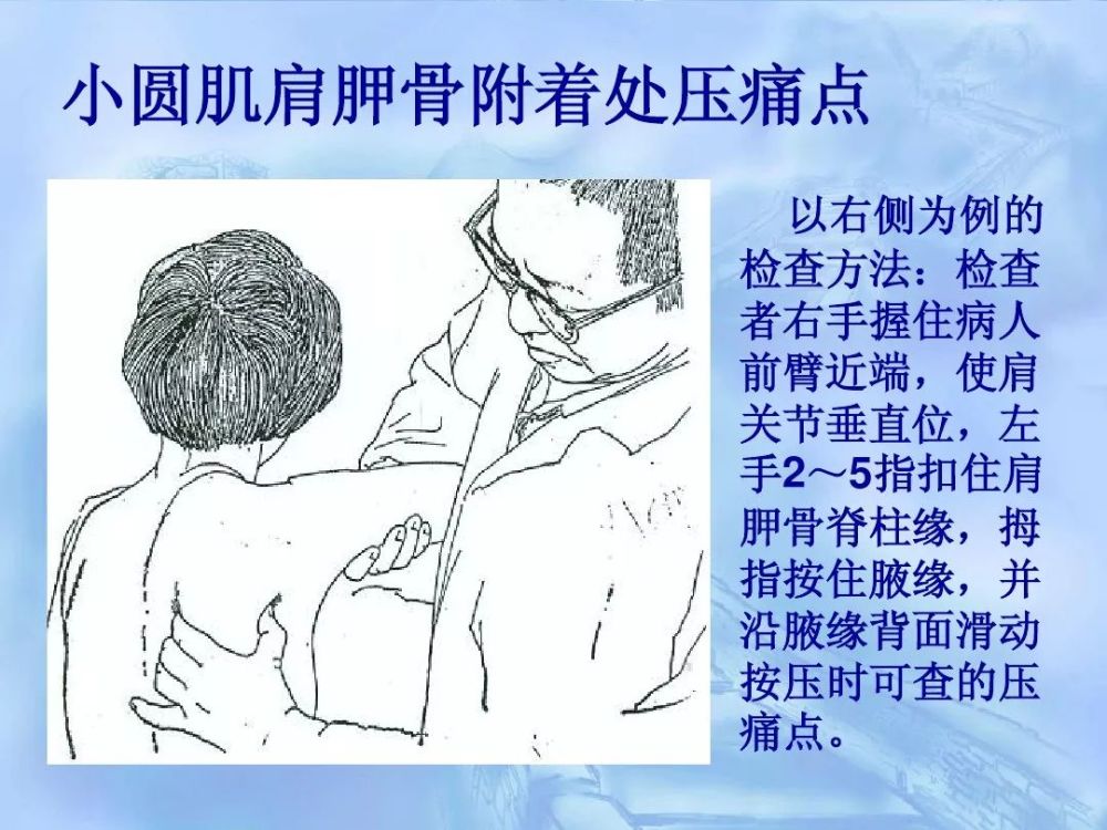 劳损性肌肉压痛点诊断检查法
