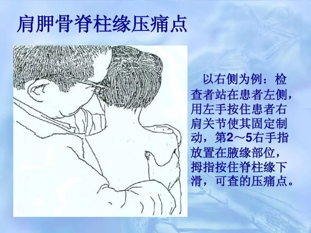 劳损性肌肉压痛点诊断检查法