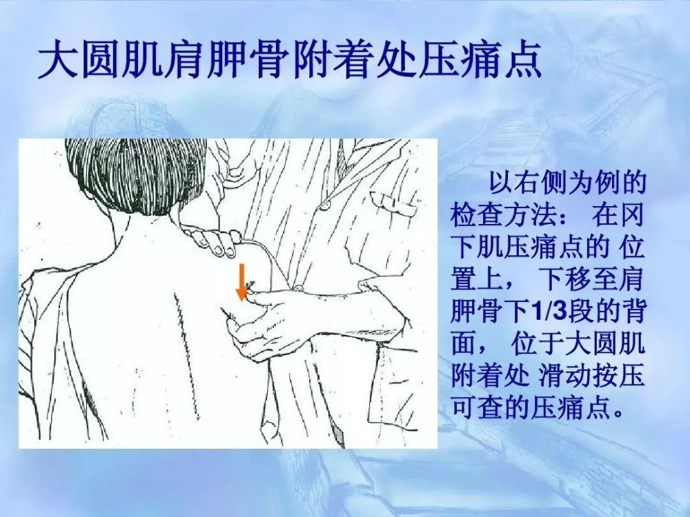 劳损性肌肉压痛点诊断检查法