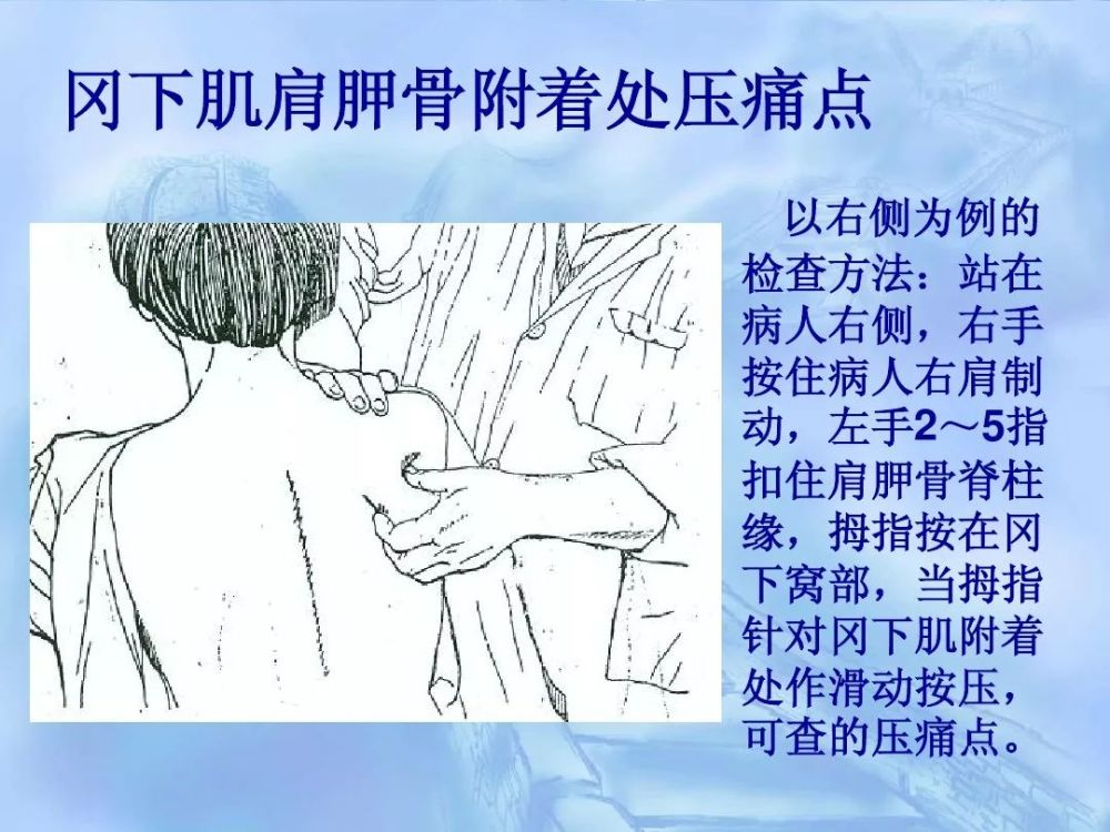 劳损性肌肉压痛点诊断检查法