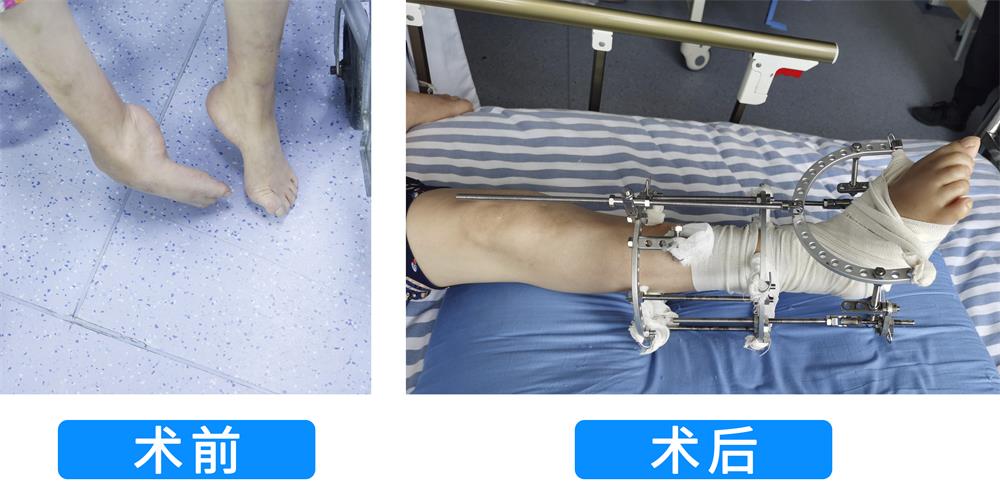合肥康华医院肢体矫形手术:修复畸形,重获新生