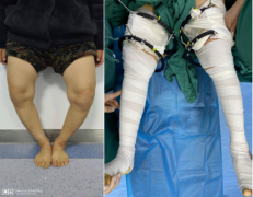 股骨矫形+伊利扎洛夫技术，塑造健康腿型
